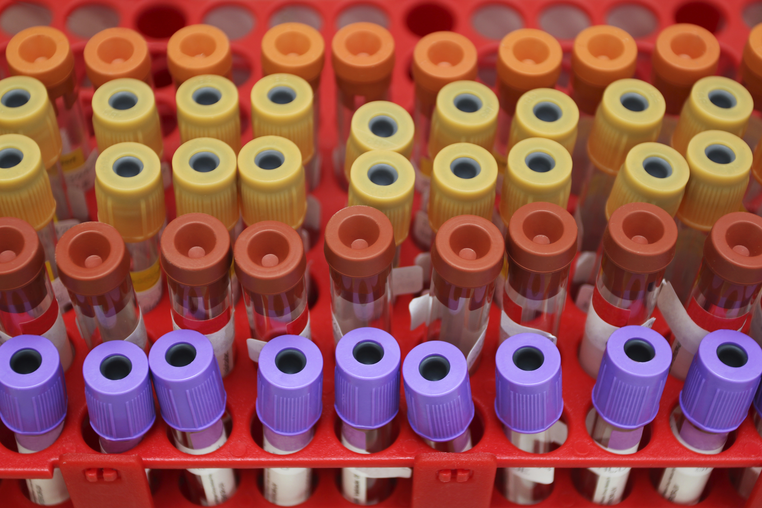 Our new blood test could be the key to detecting bowel cancer at it's earliest stage. Image: iStock.