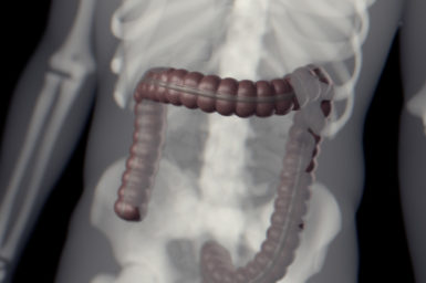 An x-ray of an abdomen showing bones and the large intestine in dark red