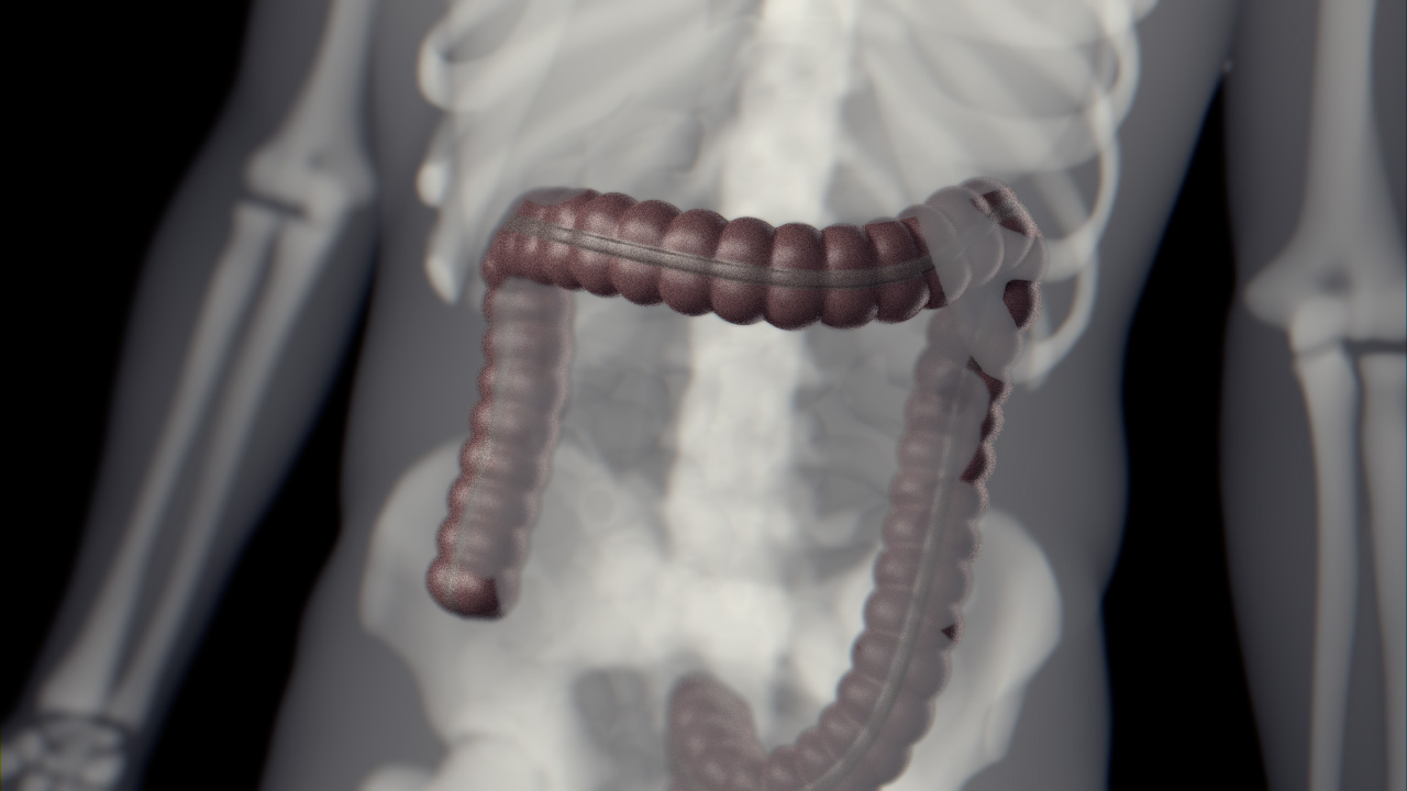 An x-ray of an abdomen showing bones and the large intestine in dark red