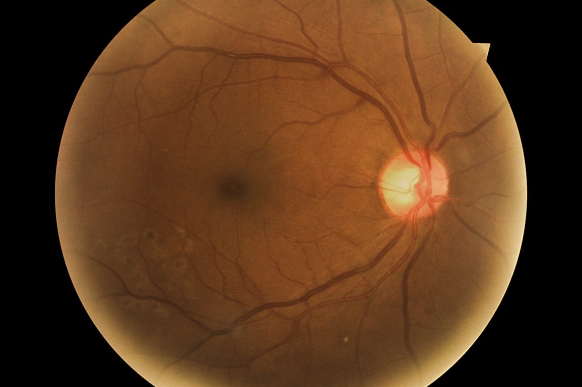 A retinal image