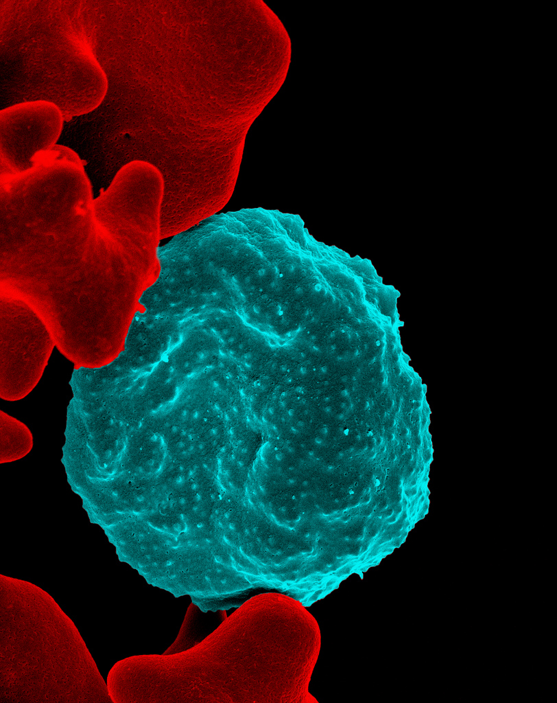 A red blood cell infected with malaria parasites (blue). Image: NIAID. 
