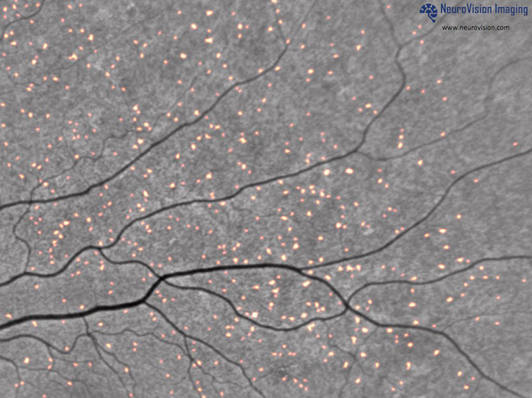 Bright spots showing Alzheimer's plaques in retinal scan