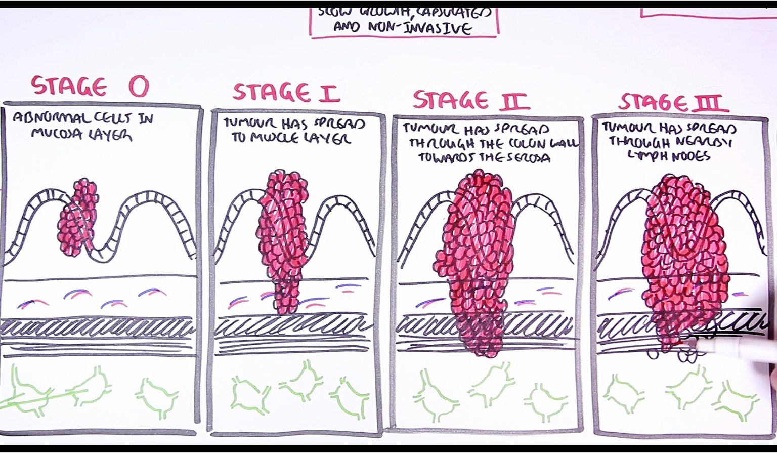 The Hungry Microbiome Part 4 The Colon Colon Cancer And Butyrate