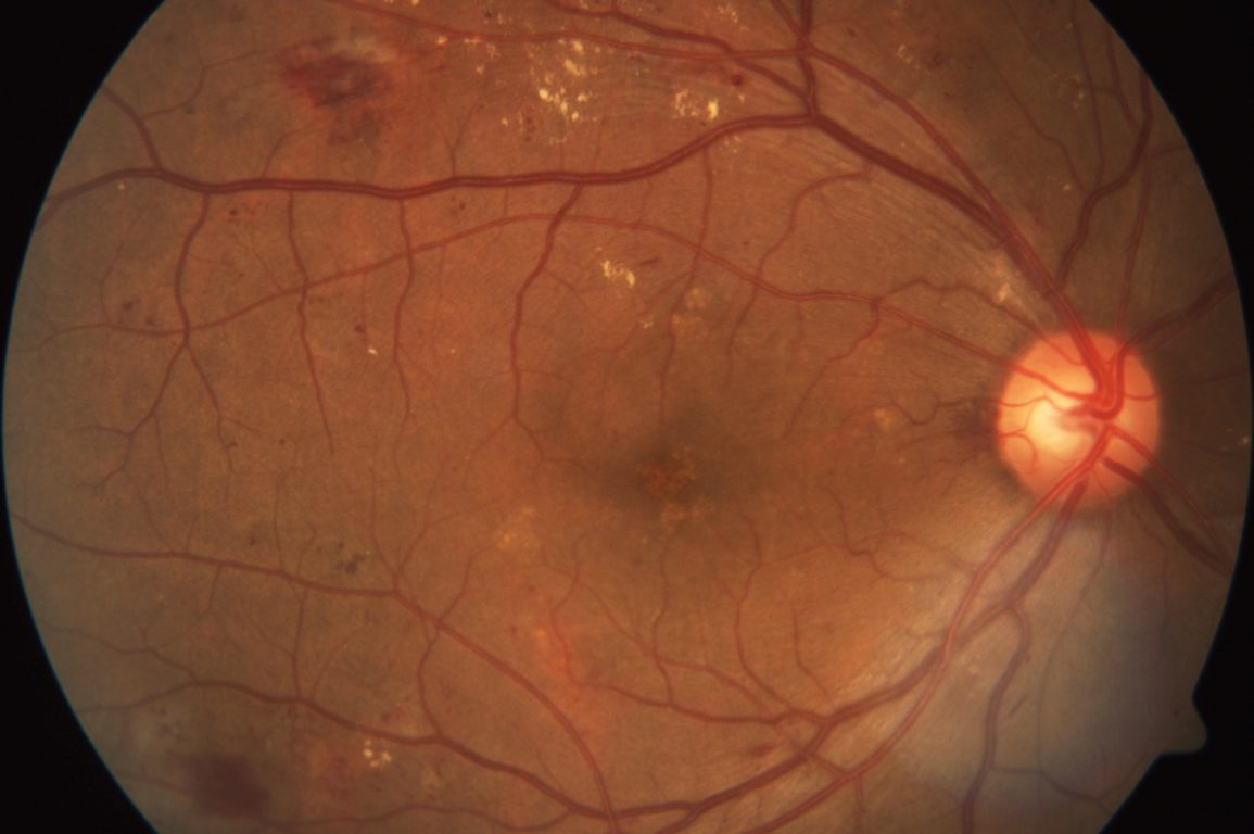 A scan of a retina showing signs of diabetic retinopathy.