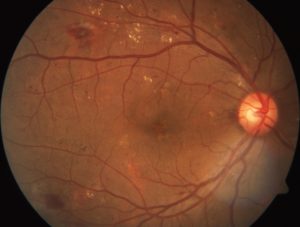 A scan of a retina showing signs of diabetic retinopathy.