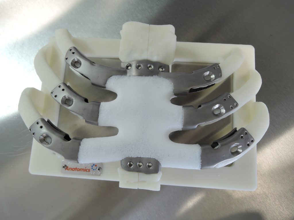 The 3D printed implant as shipped on its mount. Image: Anatomics