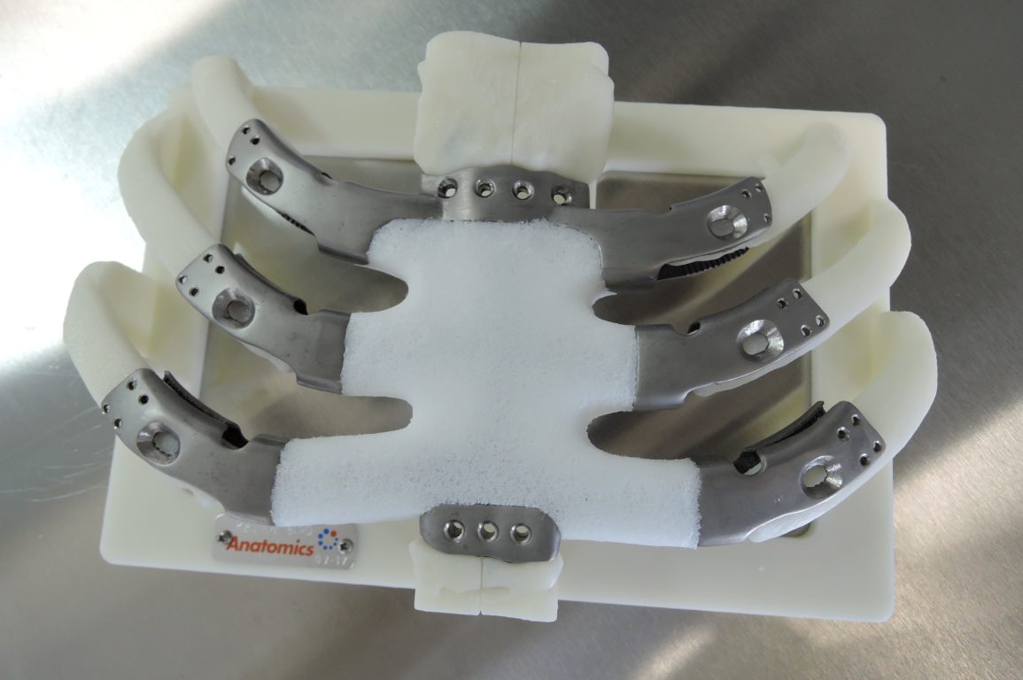 The 3D printed implant as shipped on its mount. Image: Anatomics