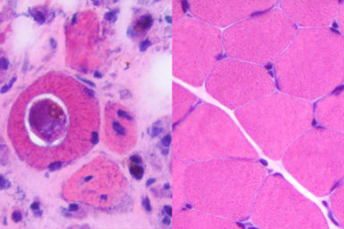 (Left) A section of muscle cells under a microscope showing an infecting H. perplexum parasite—the round structure with the white halo inside the larger mid-pink structure of the muscle cell. The patient has significant muscle deterioration—most of the dark blue/purple spots are muscle cell nuclei and in a healthy muscle (right), would have a full, muscle cells around them.
