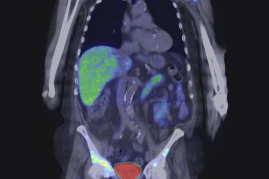 A PET scan of a human body, showing glowing areas indicating cancer cells.